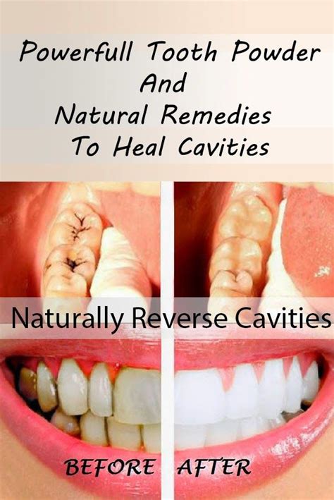 So how can you reverse cavities naturally? How To Reverse Natural Tooth Decay And Remineralize Teeth ...