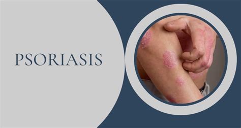 Understanding Psoriasis Qanda With A Leading Dermatologist