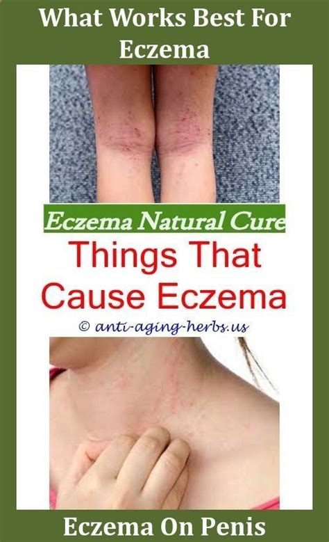 Psoriasis Vs Eczema Emma Guttman Eczemashea Butter For Eczema On Face