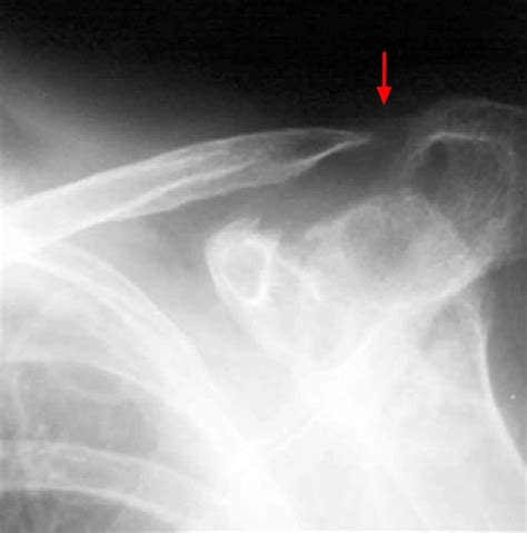Osteolysis Definition Distal Clavicle Osteolysis And Periprosthetic