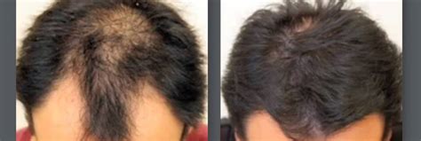 Neograft The Most Advanced Technology In Hair Restoration Is