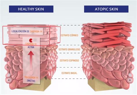 What Is Atopic Dermatitis Or Atopic Eczema Dermatology Leti Pharma