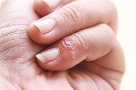 Blisters On Finger Stock Photos Pictures And Royalty Free Images Istock