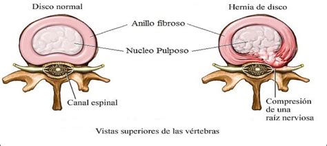 Tratamiento De Una Hernia Discal Natt Center Fisioterapia Y Osteopatía