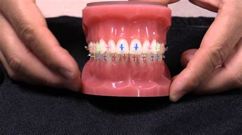 American Orthodontics Radiance Plus Visual Placement Aids Vpas Youtube