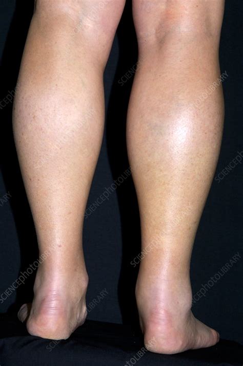 Torn Calf Muscle Stock Image M3301274 Science Photo Library