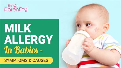 Milk Allergy In Babies Causes And Signs Youtube