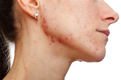 How Do I Treat Acne Scars With Picture