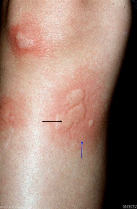 Chronic Urticaria Is Defined By Symptoms Lasting For More Than Six