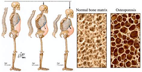 Osteoporosis Causes Risk Factors And Treatment Symptoms Medications