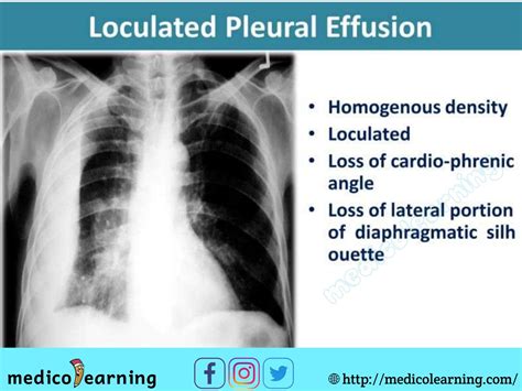 Pleural Effusion Chest X Ray