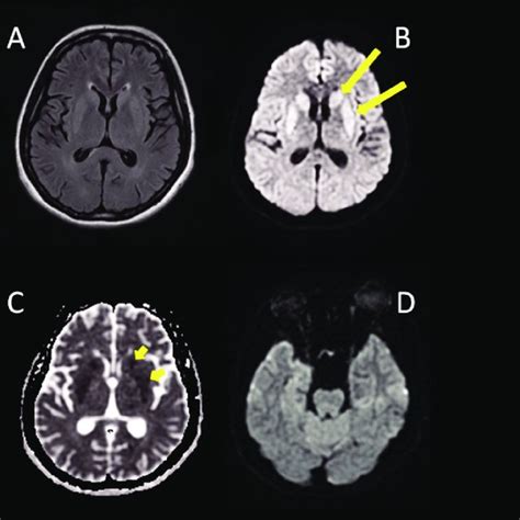 Axial Brain Mri Performed One Day After Symptom Onset Showing