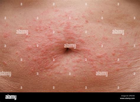 Skin Eruption Hi Res Stock Photography And Images Alamy