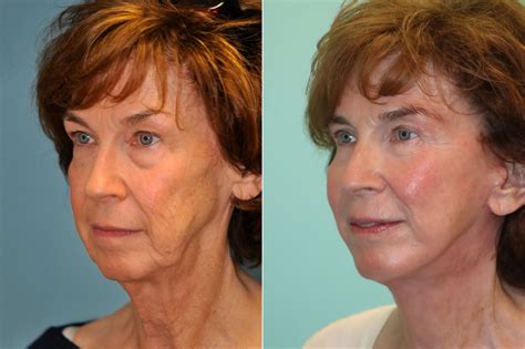 Facelift Neck Lift Photos Chevy Chase Md Patient 22610