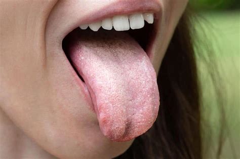 Can Candida Cause Lip Swelling Sitelip Org