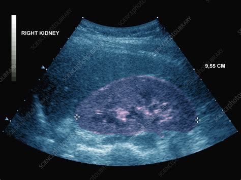 Healthy Kidney Ultrasound Scan Stock Image P5500252 Science