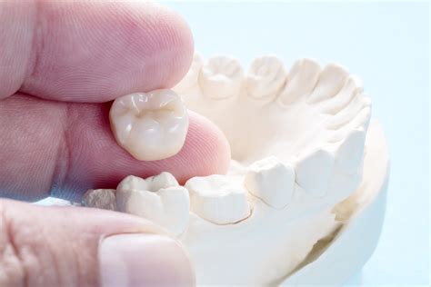 Dental Crowns Frederick MD | Same-Day Dental Restorations