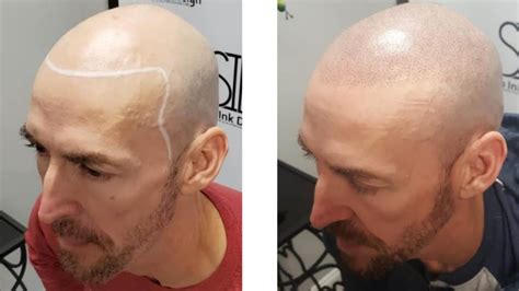Hair Tattoo Before And After Scalp Ink Design Miami Margate West