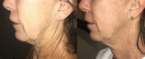 Skin Tightening With Morpheus8 Rf Microneedling Treatment Dr Clevens