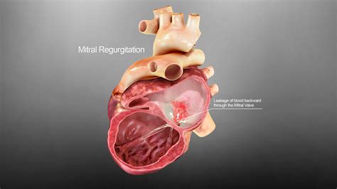 Mitral Regurgitation Cardiovalve