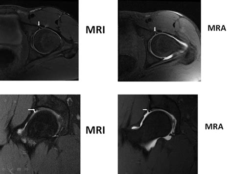 What Do You Think About The Mr Arthrography Of The Hip Researchgate