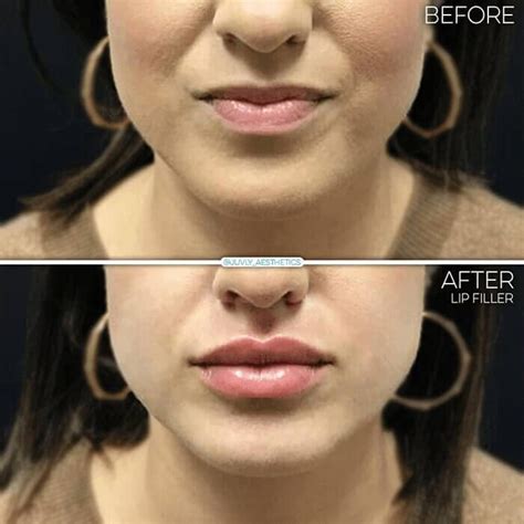 Juvly Aesthetics Lip Injections For Natural Well Defined Plump Lips