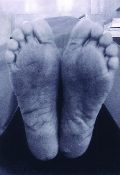 Soles Showing Diffuse Areas Of Hyperkeratosis Download Scientific