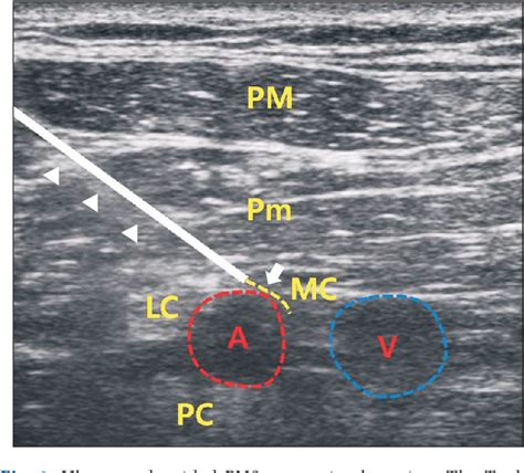 Figure 3 From Lead Fracture Of Peripheral Nerve Stimulator For Brachial