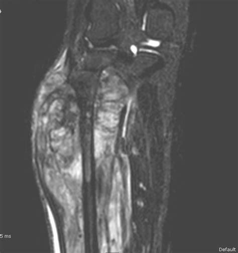 Fibular Osteosarcoma Imaging Sumer S Radiology Blog