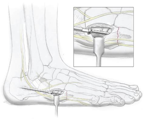 Figure 3 From Approach To Proximal Fifth Metatarsal Fracture Fixation The Lateral Dorsal