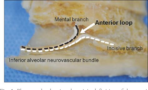 Mental Foramen Anterior Loop