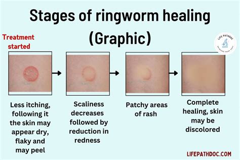 Ringworm Stages Of Healing With Pictures