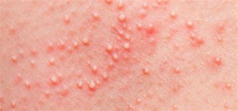 Rash With Small White Bumps That Itch General Health Rashes