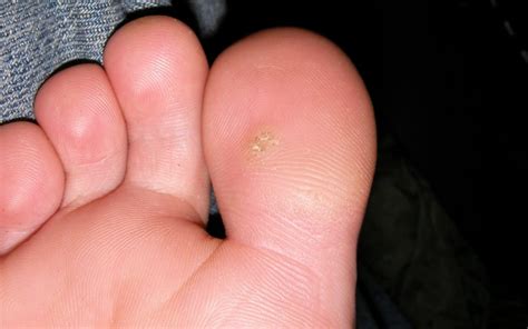 What Are Plantar Warts And How Do You Treat Them