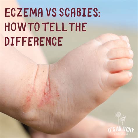 Eczema Vs Scabies How To Tell The Difference
