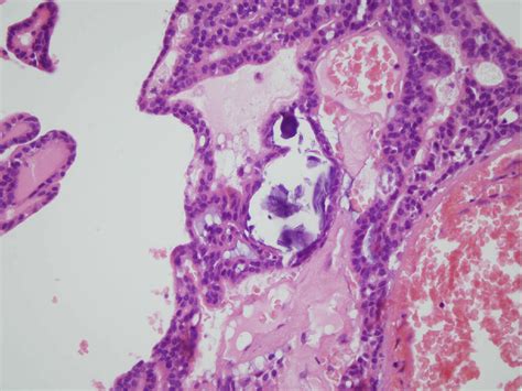 Papillary Cystadenoma Of A Minor Salivary Gland Report Of A Case