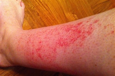 Red Rashes On Lower Leg Pictures Photos