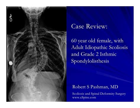 Case Review 31 60 Year Old Female With Adult Idiopathic Scoliosis