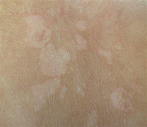 Get the facts on tinea versicolor (pityriasis versicolor) causes, signs, symptoms, and skin fungus treatment. Tinea Versicolor: What It Is And How To Treat | Family Savvy