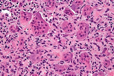 Giant Cell Lesions Libre Pathology