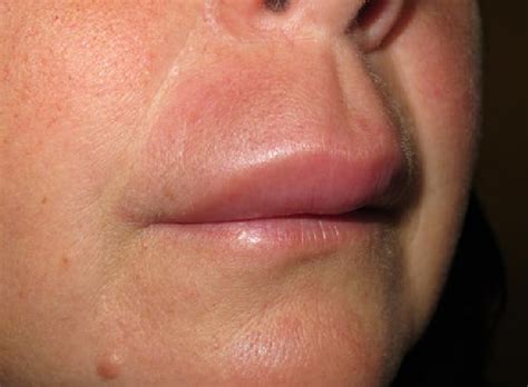 Lip Angioedema In A Patient With Chronic Spontaneous Urticaria