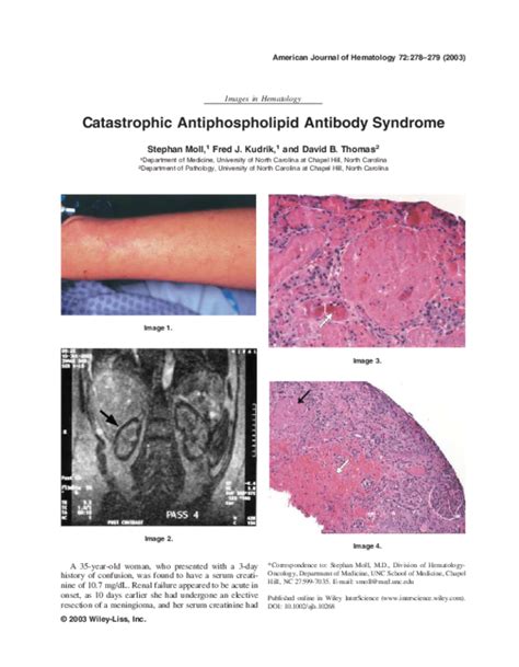 Pdf Catastrophic Antiphospholipid Antibody Syndrome Srilekha Karthik