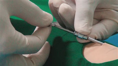 Pemasangan Dan Pelepasan Kontrasepsi Implant Youtube