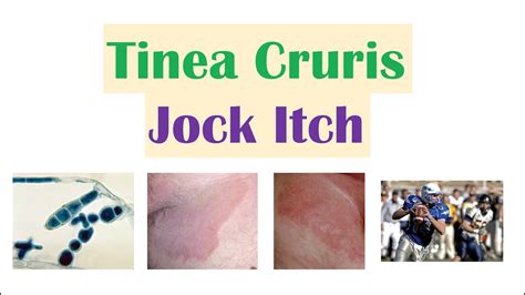 Jock Itch Tinea Cruris Causes Risk Factors Signs Symptoms
