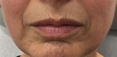 Dermal Fillers Lips Before And After Lipstutorial Org