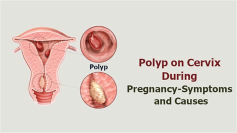 Polyp On Cervix During Pregnancy Symptoms And Causes