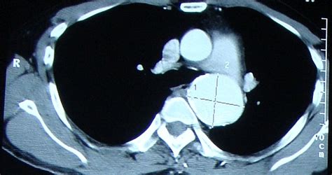 Aneurysm Of Proximal Descending Thoracic Aorta On X Ray Chest Pa View