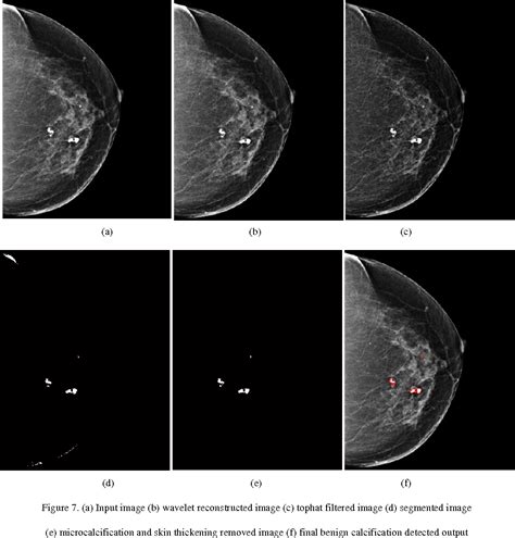 Pdf Benign Calcification Detection In Mammogram Images Semantic Scholar