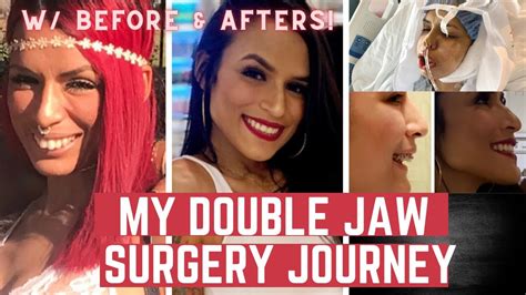 My Double Jaw Surgery And Braces Journey To Correct My Overbite With