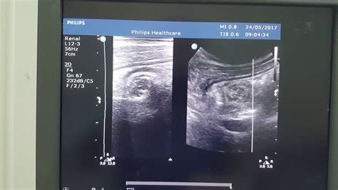 Intussusception Ultrasound Short Clip Youtube